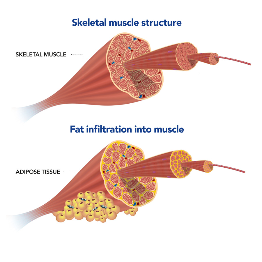 Co Existence Of Hepatosteatosis And Skeletal Muscle Fat Infiltration