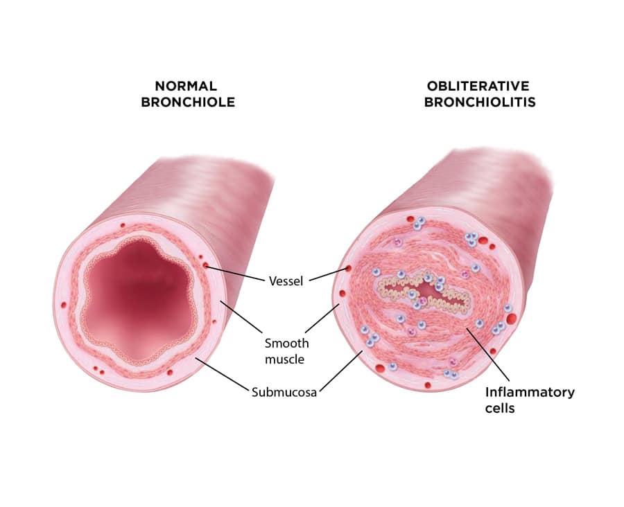 bronchiolitis