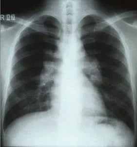 BHL-chest-X-ray-image-of-