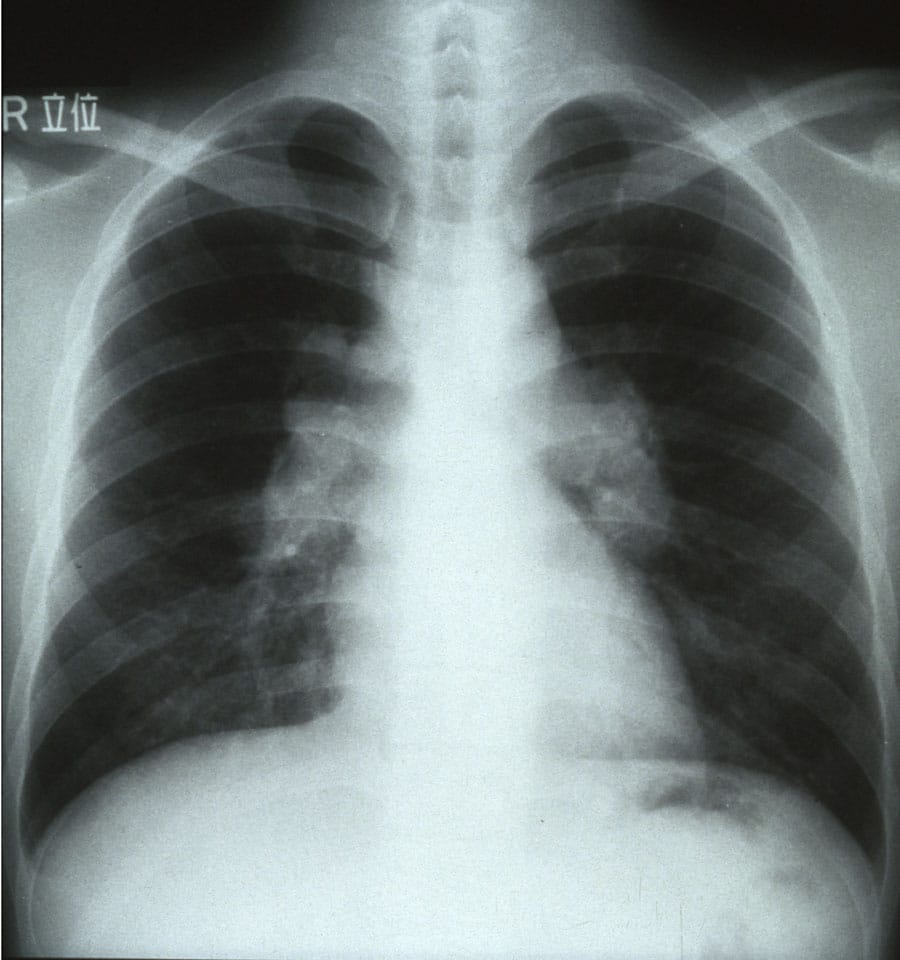 Sarcoidosis Chest X Ray