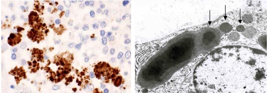 Shining a light on sarcoidosis: The path from infection to treatment