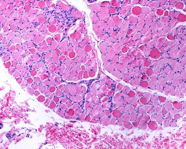 Stem cells could offer hope for muscular dystrophy - Research Outreach