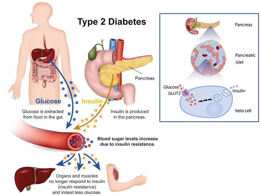 pancreas diabetes diagram