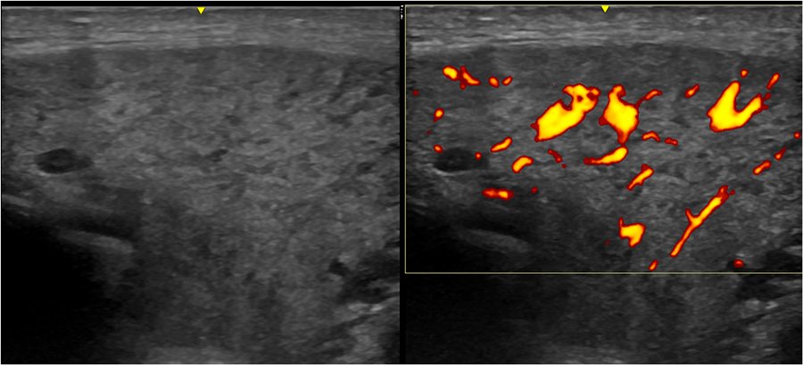 Diagnosing Sjögrens Syndrome With Salivary Gland Ultrasound Research