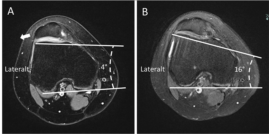 New possibilities: Same-day surgery for trochlear dysplasia - Research ...