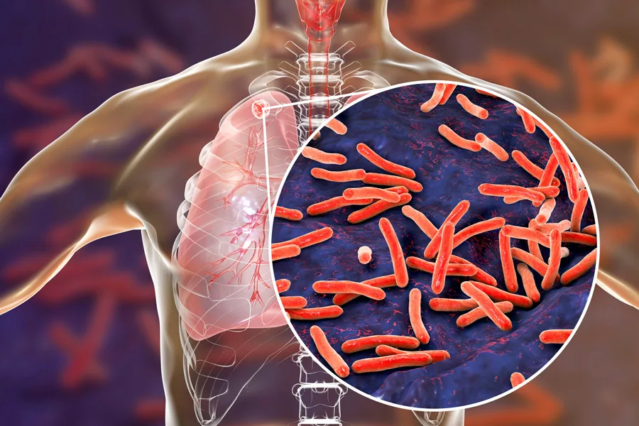 An image showing a cross-section of a human body, showing the parasites that can cause tuberculosis