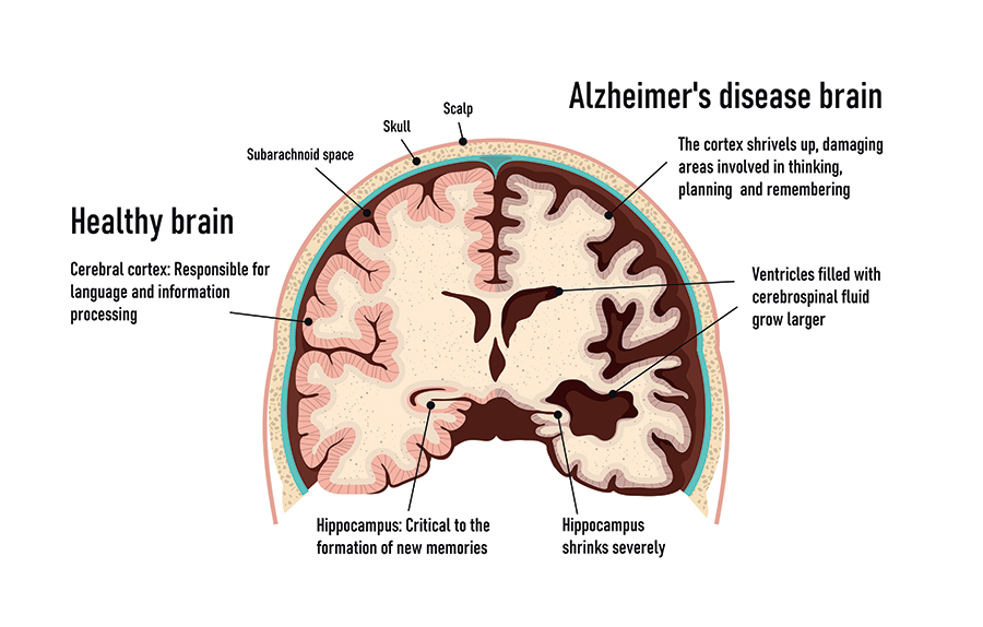 Neuropathological Changes In Alzheimers Disease AD